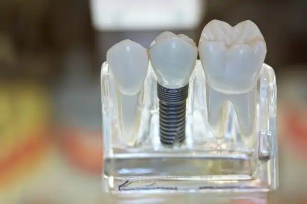 Check-Up Appointments After Dental Implant Placement