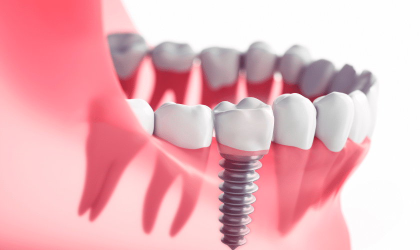 Experience Freedom to Smile: Dental Implants for Independence Day in Chandler, AZ