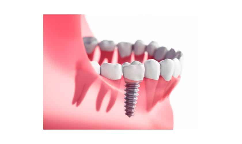 dental implants in chandler
