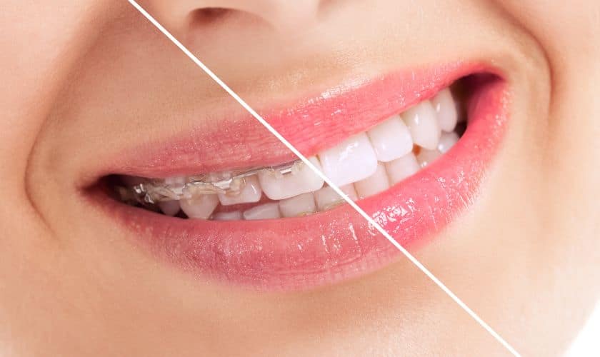 How Long Do I Need to Wear a Retainer After Braces?